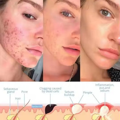 AureLase™ - Facial Wand